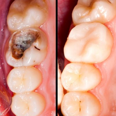 Root Canal & Inlay