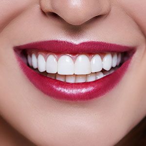 White Dental Restorations (Fillings, Inlays, and Onlays)